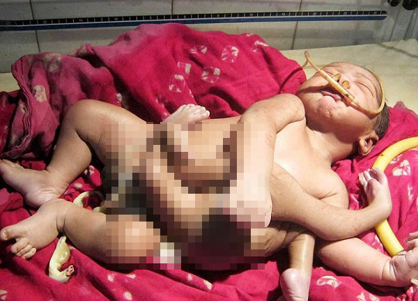 Bé sơ sinh 4 chân 4 tay chào đời ở Ấn Độ