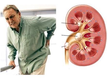 Điều trị sỏi mật bằng Kim Nguyên Tan Sỏi Hoàn