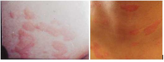 Hỏi đáp về bệnh dị ứng