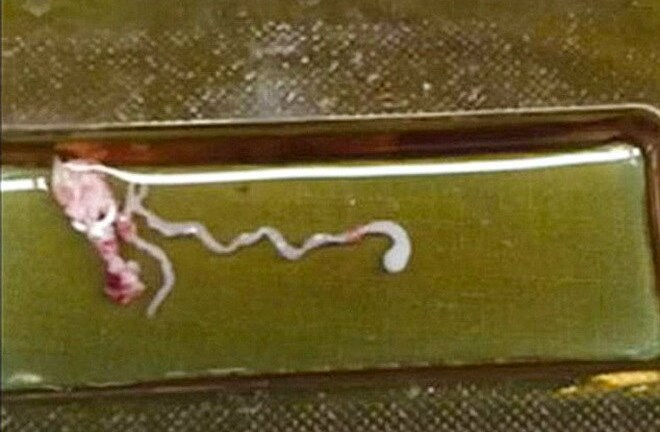 Hãi hùng cậu bé 11 tuổi bị con sán dây 8cm “làm tổ” trong đầu