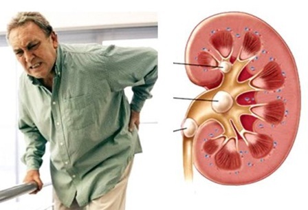 Triệu chứng và cách điều trị bệnh sỏi thận