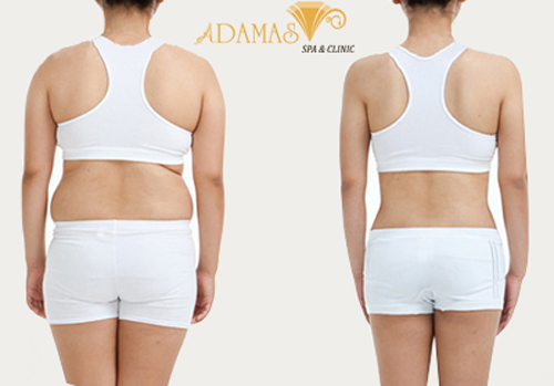 Giảm béo không phẫu thuật: thông kinh lạc