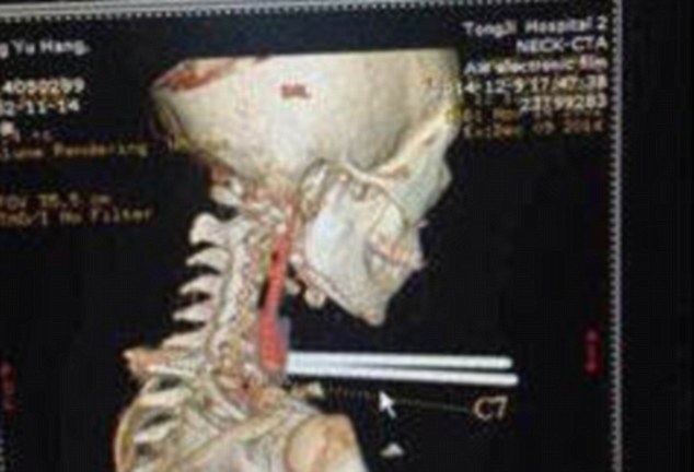 Bị đũa cắm sâu vào cổ, bé trai thoát chết thần kỳ