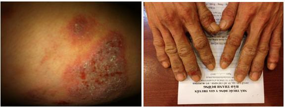 Bảo thanh đường  điều trị chàm hiệu quả nhất