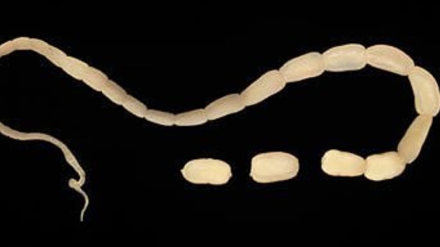 Video: Phát hiện ký sinh trùng dài 2m sống trong người 4 năm