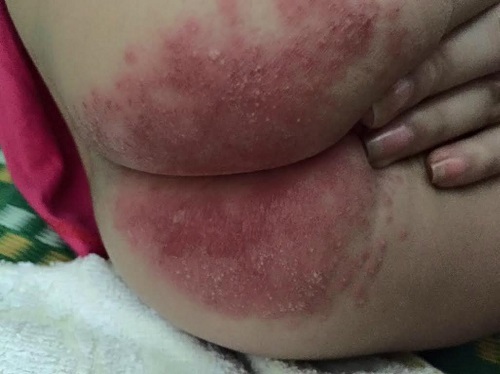 Cảnh báo cha mẹ: Con bị hỏng bộ phận sinh dục vì lạm dụng bỉm