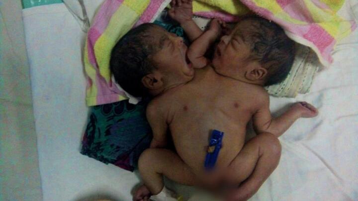 Cặp song sinh dính liền bị bố mẹ bỏ rơi trong bệnh viện