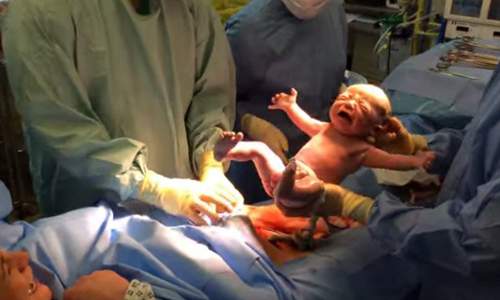 Bé trai tự bò khỏi bụng mẹ giữa ca sinh gây sốt