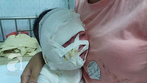 Mẹ sơ sẩy, con trai 11 tháng tuổi bị ấm siêu tốc gây bỏng nặng