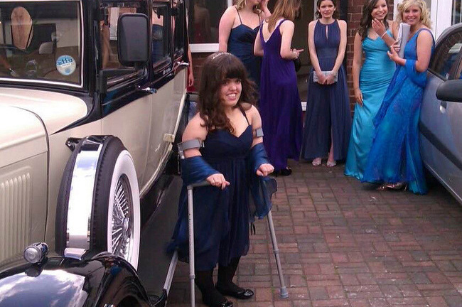 Giật mình nhìn cô gái trẻ chấp nhận đau đớn để nối dài chân thêm 18 cm