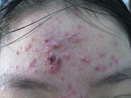 Mặt sần sùi, đỏ tấy vì 'cấy phấn' làm đẹp