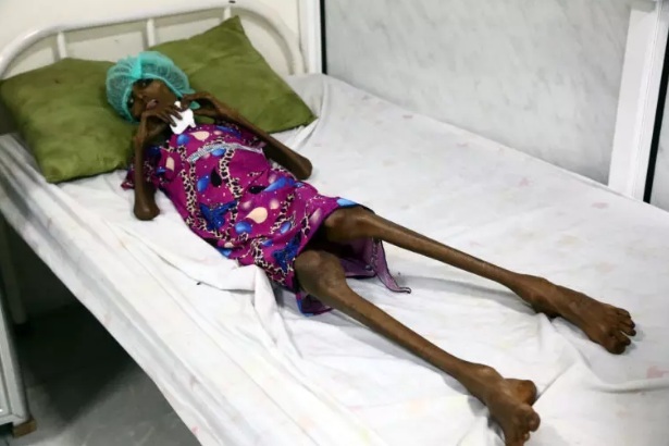 Cô gái 18 tuổi bị suy dinh dưỡng nặng chỉ còn “da bọc xương”