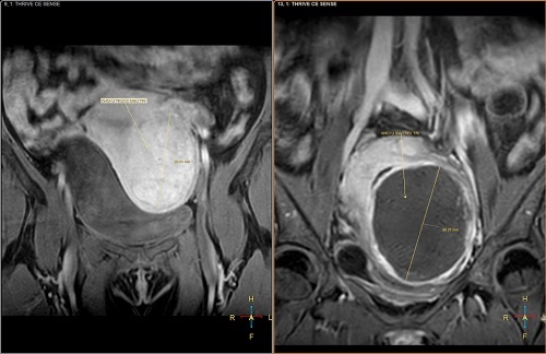 Kết quả bất ngờ khi người phụ nữ đi khám vì bị mất máu nhiều trong ngày 
