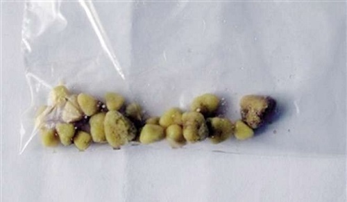 Trả giá đắt vì cố làm tan sỏi thận bằng 10 chai bia mỗi ngày