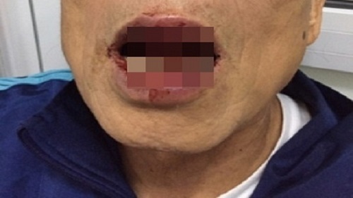 Sức khỏe Tiến sỹ 76 tuổi bị cán bộ sở Ngoại vụ đánh đang ra sao?