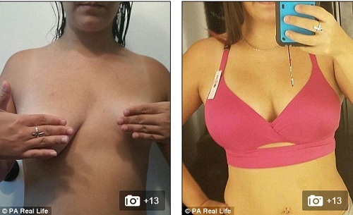 Cha lấy tiền bán nhà để giúp con gái nâng ngực