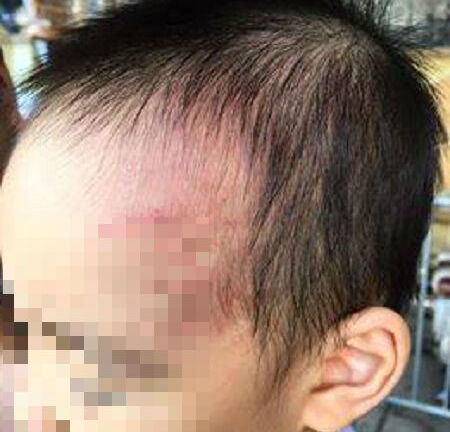 Vụ bé 18 tháng tuổi bị bạo hành: Phòng GD&ĐT lên tiếng