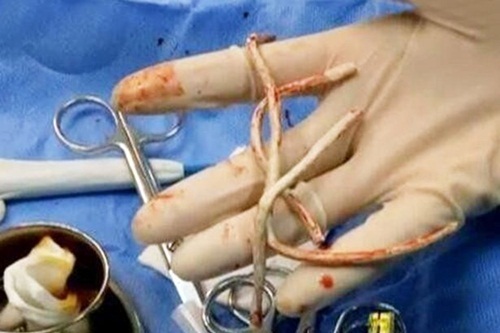 Người đàn ông bị mắc kẹt dây cáp USB trong 