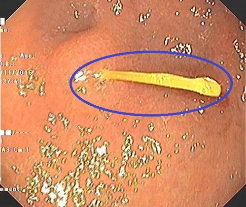 Hà Nội: Suýt thủng dạ dày vì nuốt nhầm...tăm xỉa răng