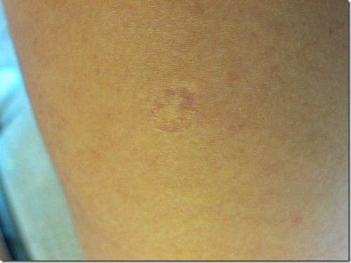 Tại sao ai cũng có vết sẹo lõm trên bắp tay trái?