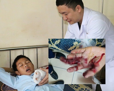 Nam sinh lớp 7 bị dập nát bàn tay vì tự chế pháo bằng diêm