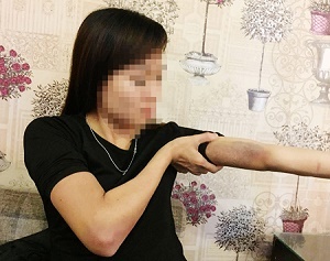 Vụ cô gái bị bạn trai nhốt, đánh đập bằng gậy sắt: Lời kể hãi hùng của nạn nhân