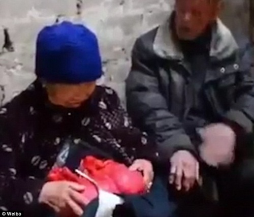 Cụ bà sống hàng thập kỷ với tình trạng ruột lòi bên ngoài cơ thể