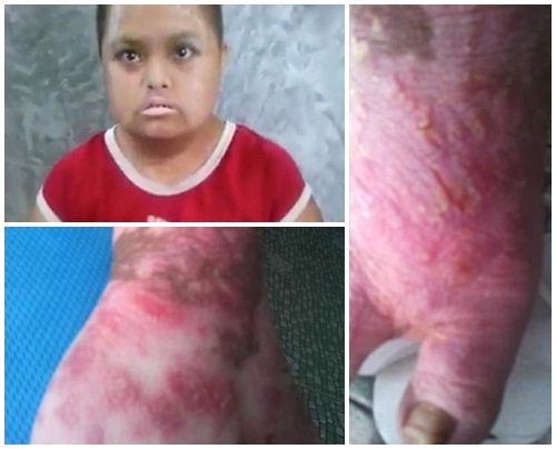 Bé gái mất khả năng đi lại, biến đổi màu da chỉ vì vết muỗi cắn 2 năm trước