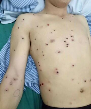 Đang kéo gỗ, người đàn ông bị hơn 50 viên đạn hoa cải găm vào người