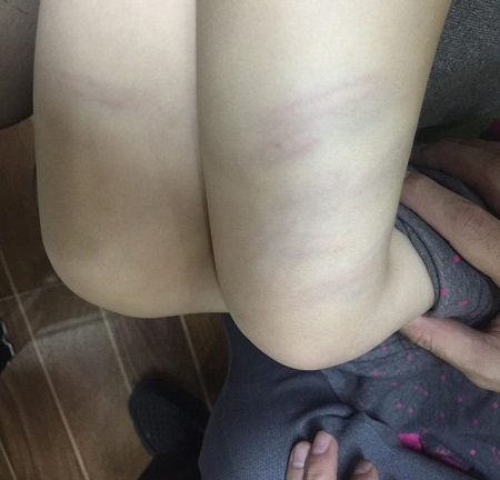 Bé gái 2 tuổi bị cô giáo dùng đũa đánh bầm tím đùi