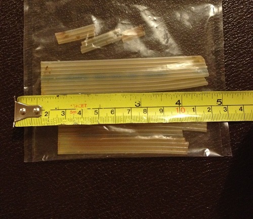 Bác sĩ bỏ quên ống nhựa dài 20cm trong bụng bệnh nhân suốt 20 năm