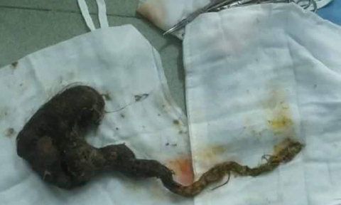 Búi tóc dài gần nửa mét trong bụng bé gái 6 tuổi