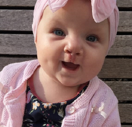 Bé gái 7 tháng tuổi cười và phát âm ngay sau lần phẫu thuật hở hàm ếch đầu tiên 