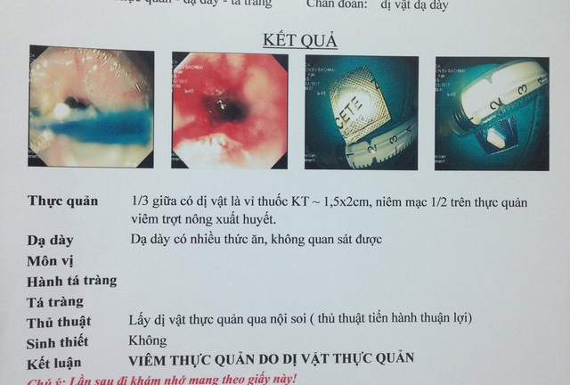 Hi hữu: Nam thanh niên hóc dị vật vì... uống thuốc quên bỏ vỏ