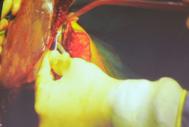 Con gái có nguy cơ 90% tử vong, bố cho nửa lá gan