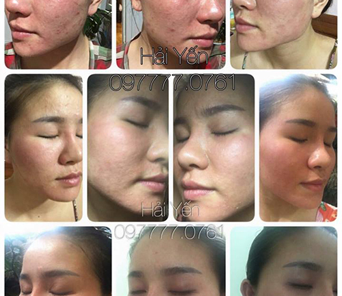 Đông y Ngọc Sâm – mụn, nám, tàn nhang không còn là nỗi lo