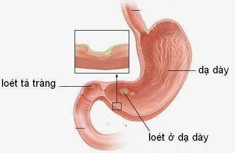 Bỏng thực quản, dạ dày do ăn phải chất độc