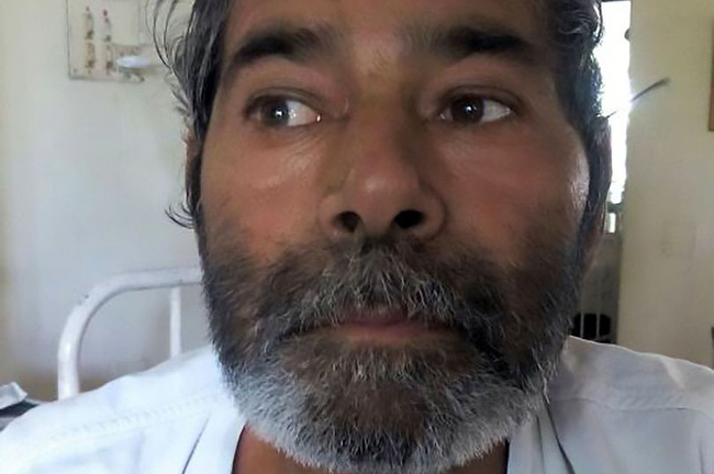 Ớn lạnh người đàn ông bị 75 cây kim găm vào người mà không hề biết