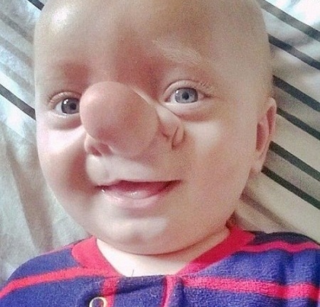 Mắc căn bệnh hiếm gặp, cậu bé mang chiếc mũi đặc biệt như nhân vật Pinocchio