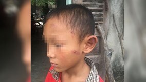 Bé trai 5 tuổi bị dì ruột bạo hành dã man