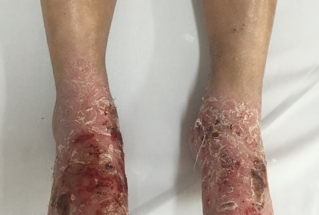 Bị đột biết gen, chân bé Quý lở loét