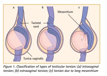 Bệnh ở quý ông: Nhầm lẫn trong chẩn đoán có thể dẫn tới vô sinh