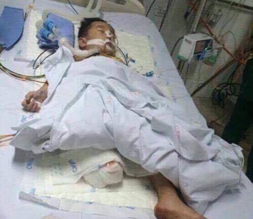 Xót xa hoàn cảnh của bé trai 5 tuổi phải cưa một chân sau tai nạn