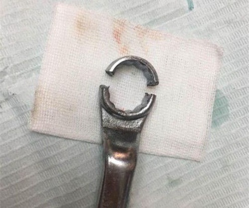 Trường hợp mắc kẹt có 1-0-2: Nhiều chuyên gia bó tay, đến khi có 1 nha sĩ xuất hiện