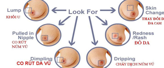 Nhận biết những dấu hiệu sớm để ung thư vú chỉ là