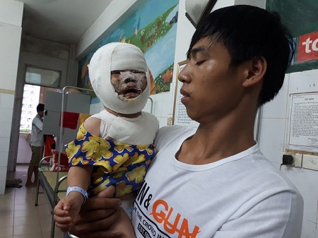 Bé 9 tháng tuổi bị biến dạng mặt vì ngã vào bếp lửa