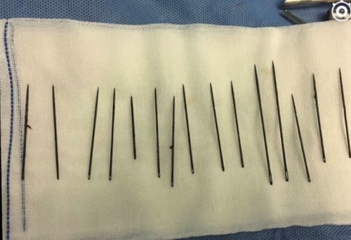 15 cây kim trong niệu đạo của quý ông