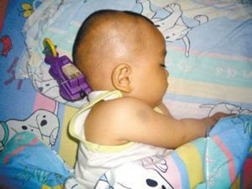 Cách xử lý thông minh của bà mẹ khi con 11 tháng tuổi bị đồ chơi cắm vào não