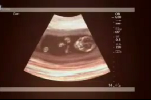 Sau ngày phá thai, người mẹ trẻ phát hiện bụng mình to lên bất thường