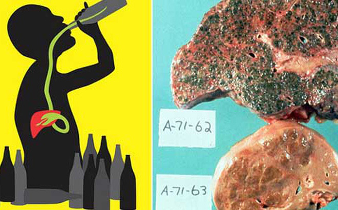 Những con số giật mình về bệnh do rượu, đa số bệnh nhân đều trẻ 30-40 tuổi đời